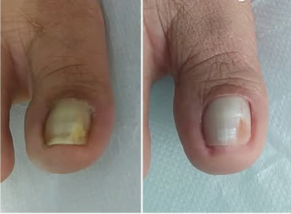 Antes e depois de cuidado podológico das unhas