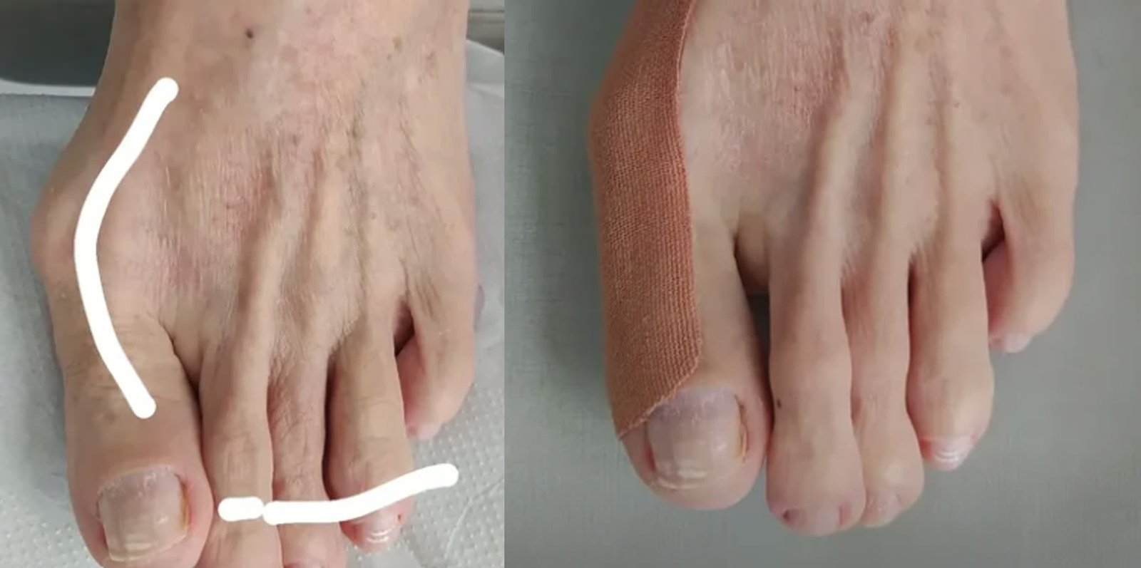 Bandagem funcional para joanete: antes e depois da aplicação