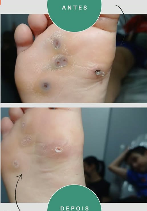 Antes e depois de tratamento de verruga plantar (olho de peixe)